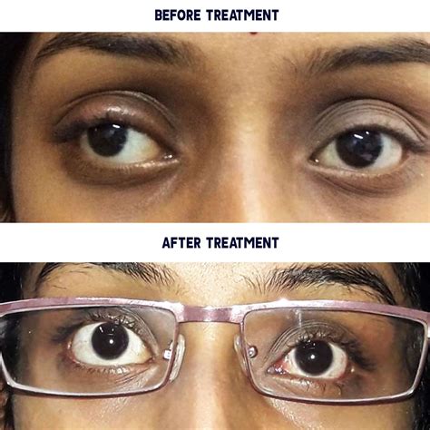 A Brighter Future: Unlocking Treatment Options for Strabismus with an Experienced Optometrist